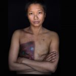 A female breast cancer patient photographed as part of Facing Chemo - reveals radiation burns and scars following a double mastectomy