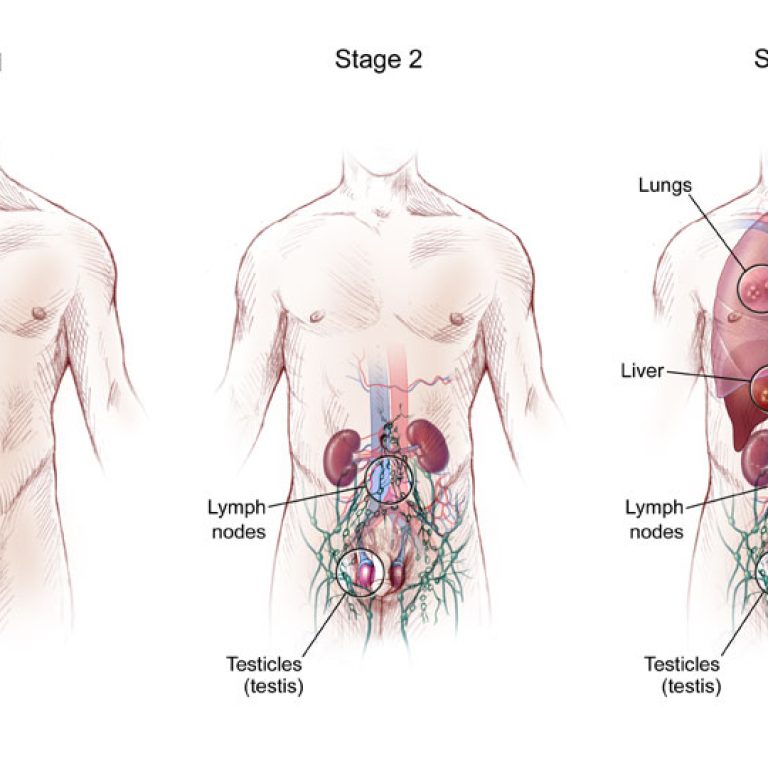 b_5597_or_anatomy_testicular_tumors